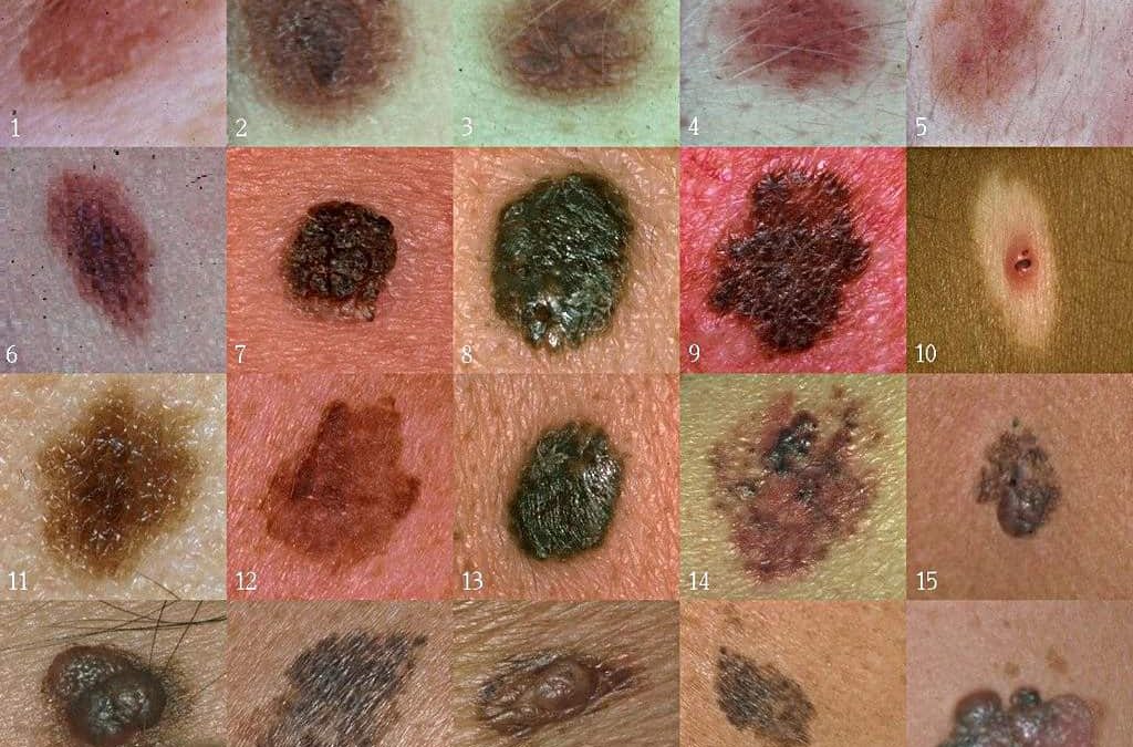 How Cannabis Might Be Used to Target Melanoma