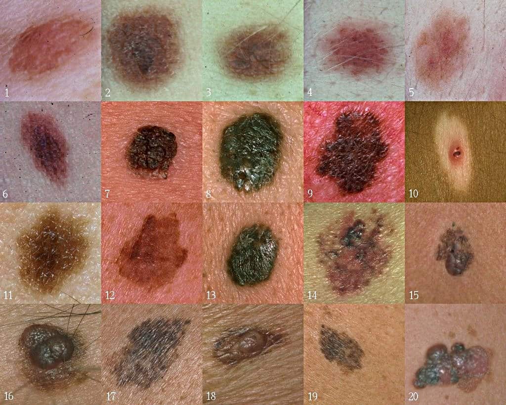 How Cannabis Might Be Used to Target Melanoma